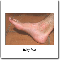 Itchy foot